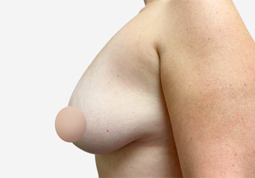 Breast Lift