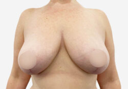 Breast Lift