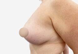Breast Lift