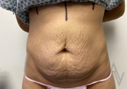 Tummy Tuck