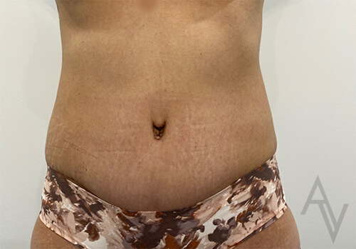 Tummy Tuck Case 3423 After Photo Tummy Tuck