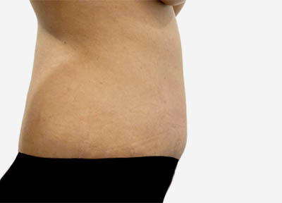 Tummy Tuck