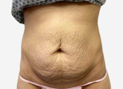 Tummy Tuck