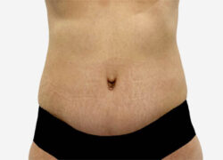 Tummy Tuck