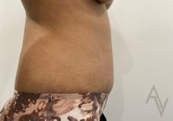 Tummy Tuck