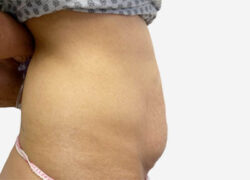 Tummy Tuck
