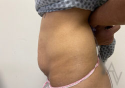 Tummy Tuck