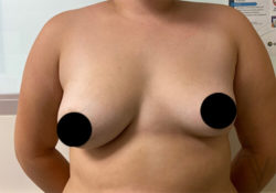 Breast Asymmetry Correction