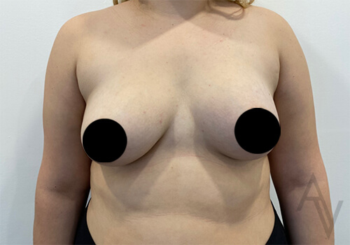 Breast Asymmetry Correction