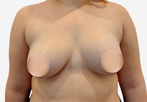 Breast Asymmetry Correction