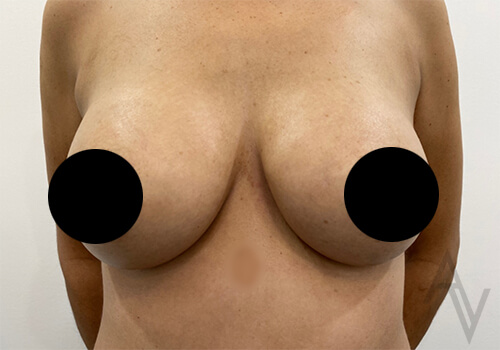 Breast Augmentation