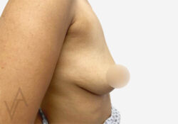 Breast Augmentation