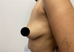 Breast Augmentation