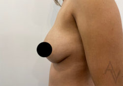 Breast Augmentation