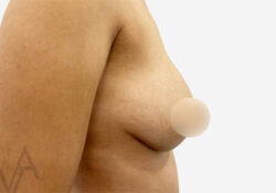 Breast Augmentation