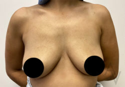 Breast Augmentation