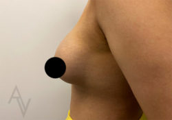 Breast Augmentation