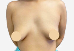 Breast Augmentation