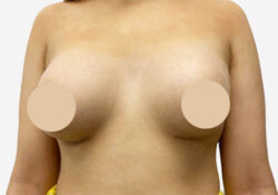 Breast Augmentation