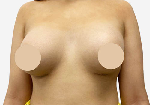 Breast Augmentation Case 3571 After Photo Breast Augmentation