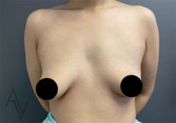 Breast Augmentation