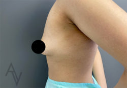 Breast Augmentation