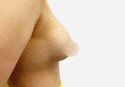 Breast Augmentation