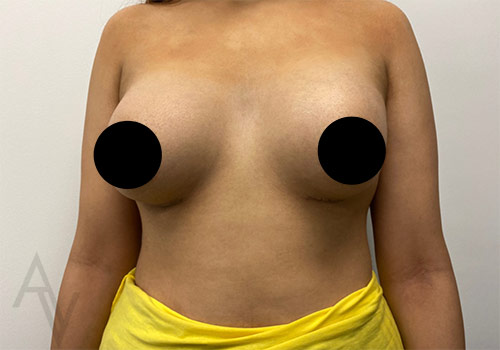 Breast Augmentation Case 3571 After Photo Breast Augmentation