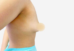 Breast Augmentation