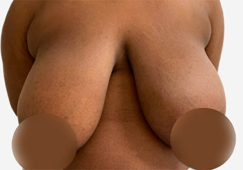 Breast Lift