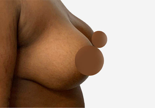Breast Lift