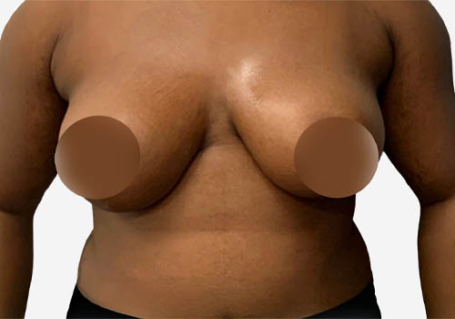 Breast Lift
