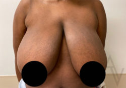 Breast Reduction