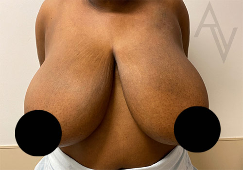 Breast Reduction