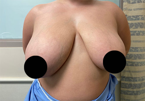 Breast Reduction