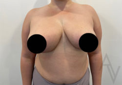 Breast Reduction