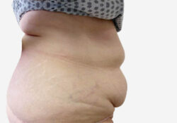 Tummy Tuck
