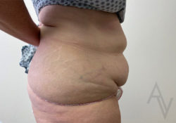 Tummy Tuck