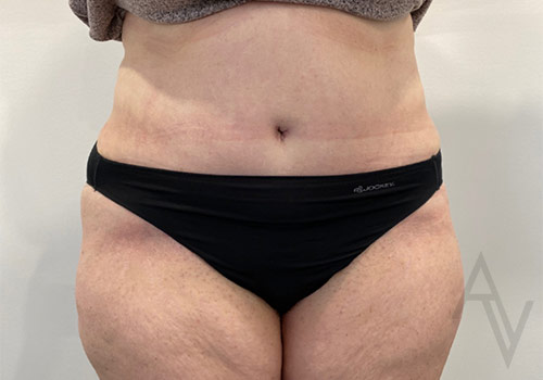 Tummy Tuck