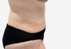 Tummy Tuck