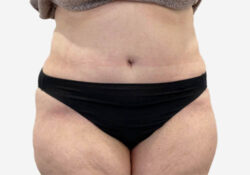Tummy Tuck