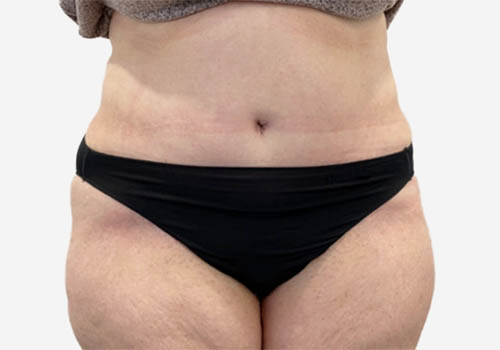 Tummy Tuck