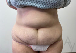 Tummy Tuck