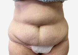 Tummy Tuck