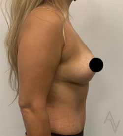 Breast Lift