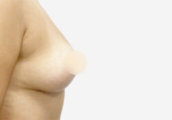 Breast Lift