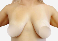 Breast Lift