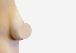 Breast Lift