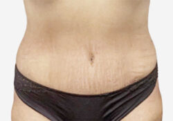 Tummy Tuck