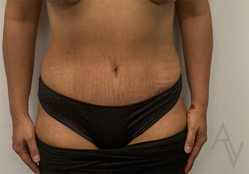 Tummy Tuck